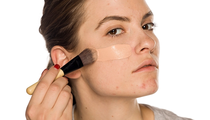 Giải Đáp Mọi Thắc Mắc Về Trị Mụn Trứng Cá Để Có Làn Da Đẹp