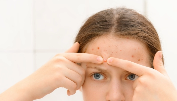 Cách trị mụn nhọt nhanh nhất tại nhà mà không cần kháng sinh