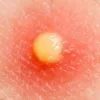 Hiểu Rõ Mụn Mủ: Nguyên Nhân, Cách Điều Trị Và Phòng Ngừa Hiệu Quả Tại Nhà