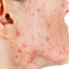Mụn nang có nguy hiểm không? Nguyên nhân, dấu hiệu và cách xử lý