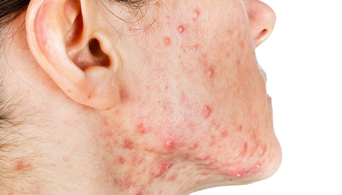 Mụn nang có nguy hiểm không? Nguyên nhân, dấu hiệu và cách xử lý