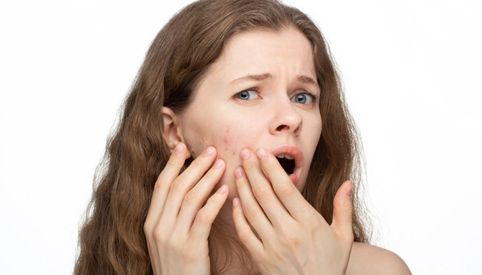 Mụn nội tiết: Cách nhận biết và điều trị tận gốc theo từng độ tuổi