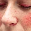 Chăm sóc da khi bị rosacea: Những điều nên và không nên làm