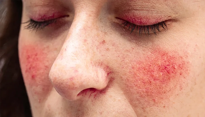 Chăm sóc da khi bị rosacea: Những điều nên và không nên làm