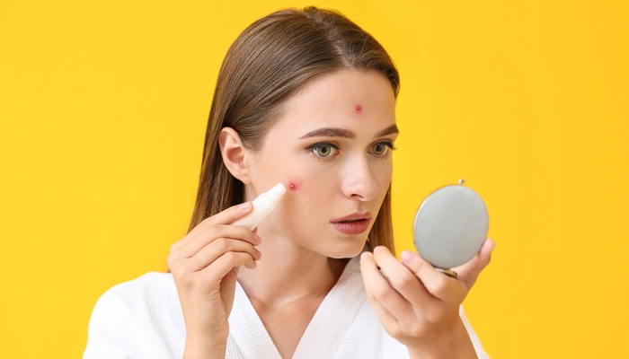 Giải Mã Dapsone: “Vũ Khí Bí Mật” Trong Điều Trị Mụn Viêm