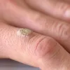 Mụn Cơm Do Virus HPV: Cách Nhận Biết, Phòng Ngừa Và Điều Trị
