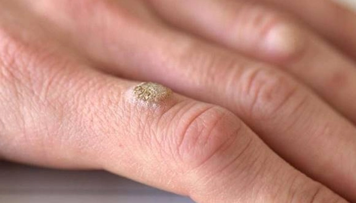 Mụn Cơm Do Virus HPV: Cách Nhận Biết, Phòng Ngừa Và Điều Trị