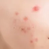 Mụn đỏ ở má: Nguyên nhân và cách điều trị đơn giản