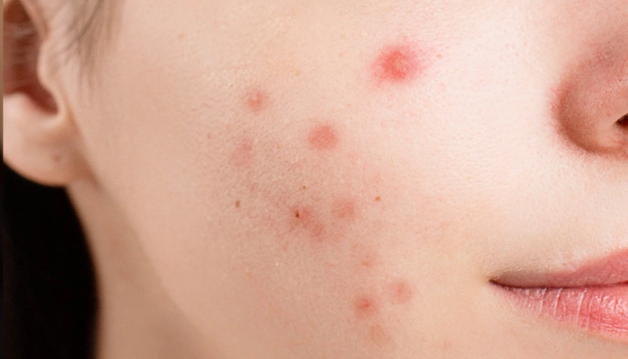 Mụn đỏ ở má: Nguyên nhân và cách điều trị đơn giản