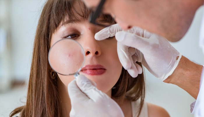 Mụn viêm kết hợp là gì? Cách điều trị tổng thể từ trong ra ngoài