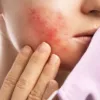 Nhận Biết Mụn Dị Ứng: Dấu Hiệu Phân Biệt Với Mụn Thông Thường