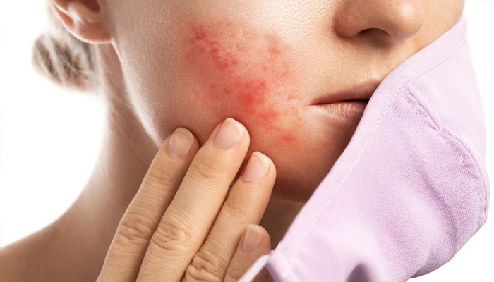 Nhận Biết Mụn Dị Ứng: Dấu Hiệu Phân Biệt Với Mụn Thông Thường
